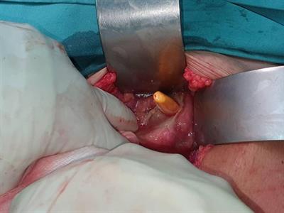 Case Report: Rectal Perforation Secondary to a Toothbrush in an Elderly Man